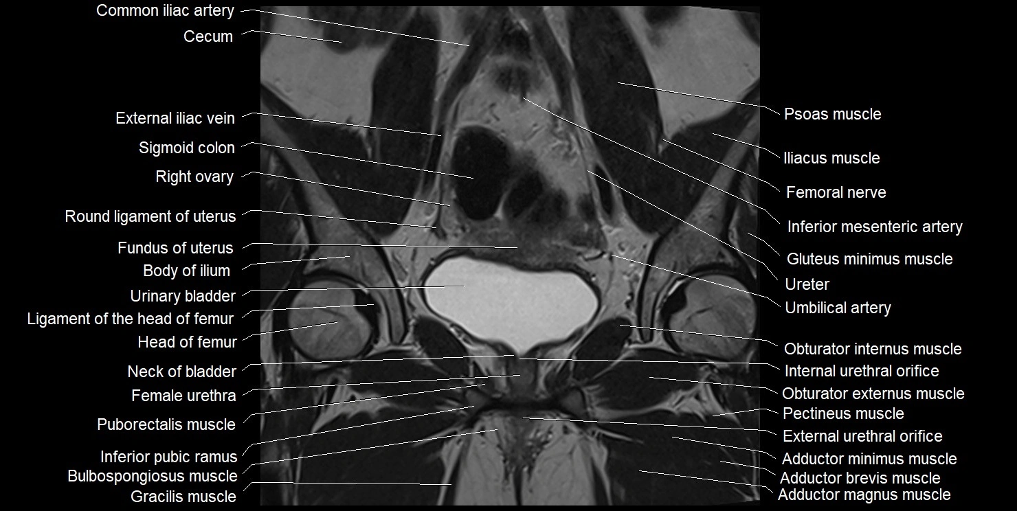 female pelvis coronal cross sectional anatomy image 15.webp